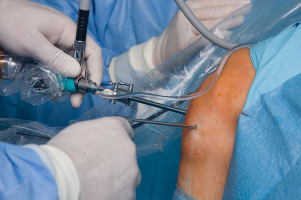 Arthroscopy