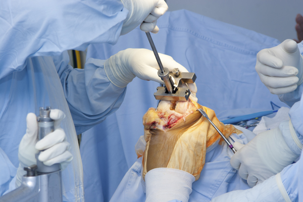 Arthroplasty