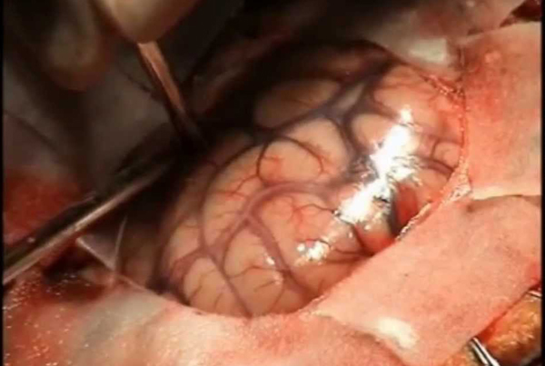 Tumor